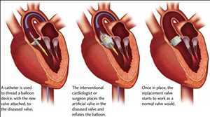 Globale Remplacement de la valve aortique par cathéter Portée future du marché